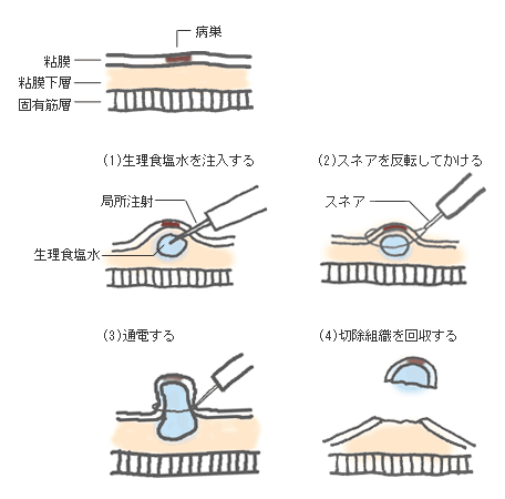 EMRの手法
